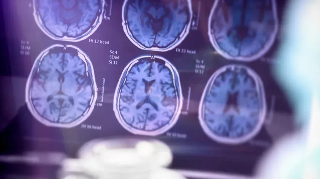 Alzheimer hastalığını yavaşlatan ilaç