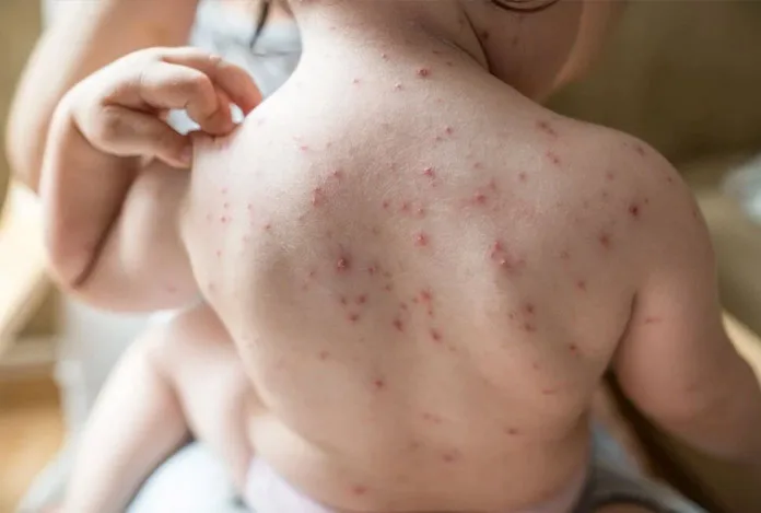 Çok bulaşıcı yeni salgın alarmı: Domates gribi